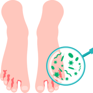 Mycose du Pied & Ongles