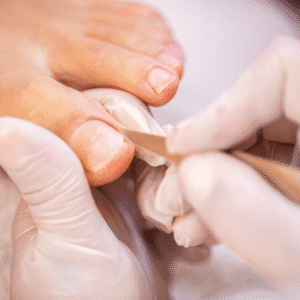 Hallux Valgus